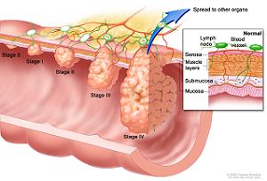 Colon Cancer