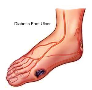 Diabetic foot ulcer