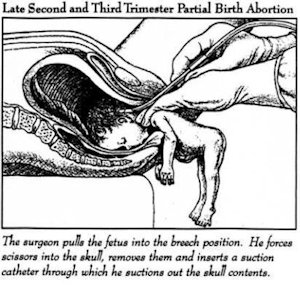 Partial birth abortion