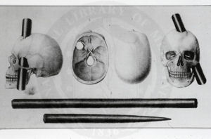 The skull of Phineas Gage