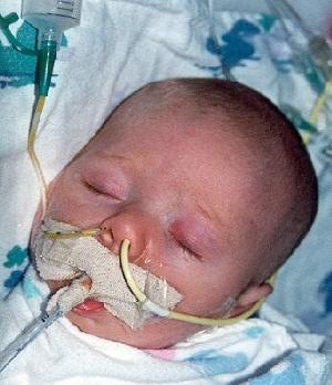 Pertussis Victim: Rachel