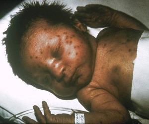 Rubella is often fatal