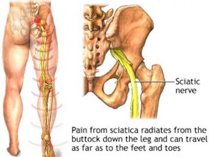 Sciatica